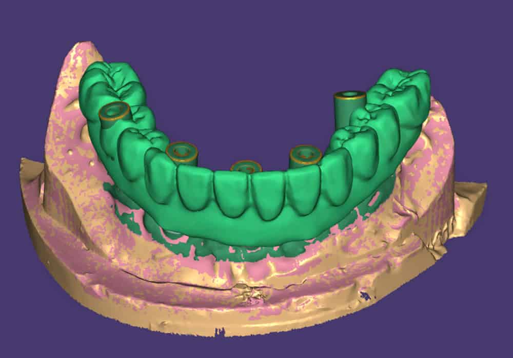 scanned-prototype-monolithic-zirconia