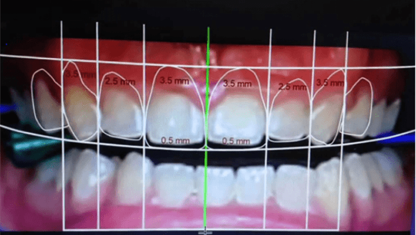 The Anterior Zone Requires Specialized Implant Strategies