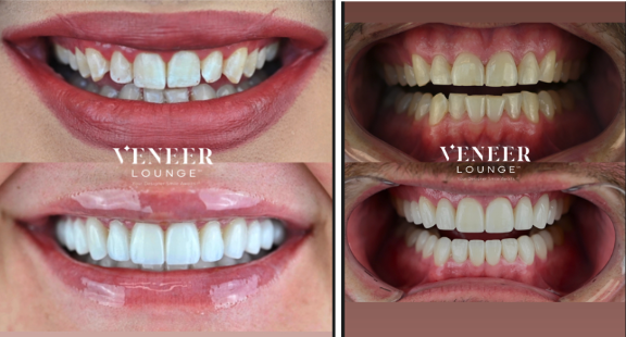The Business of Veneers: How to Convert More Smile-Makeover Cases