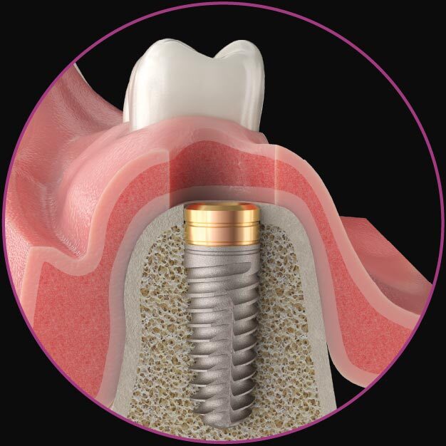 bone-level-placement-2