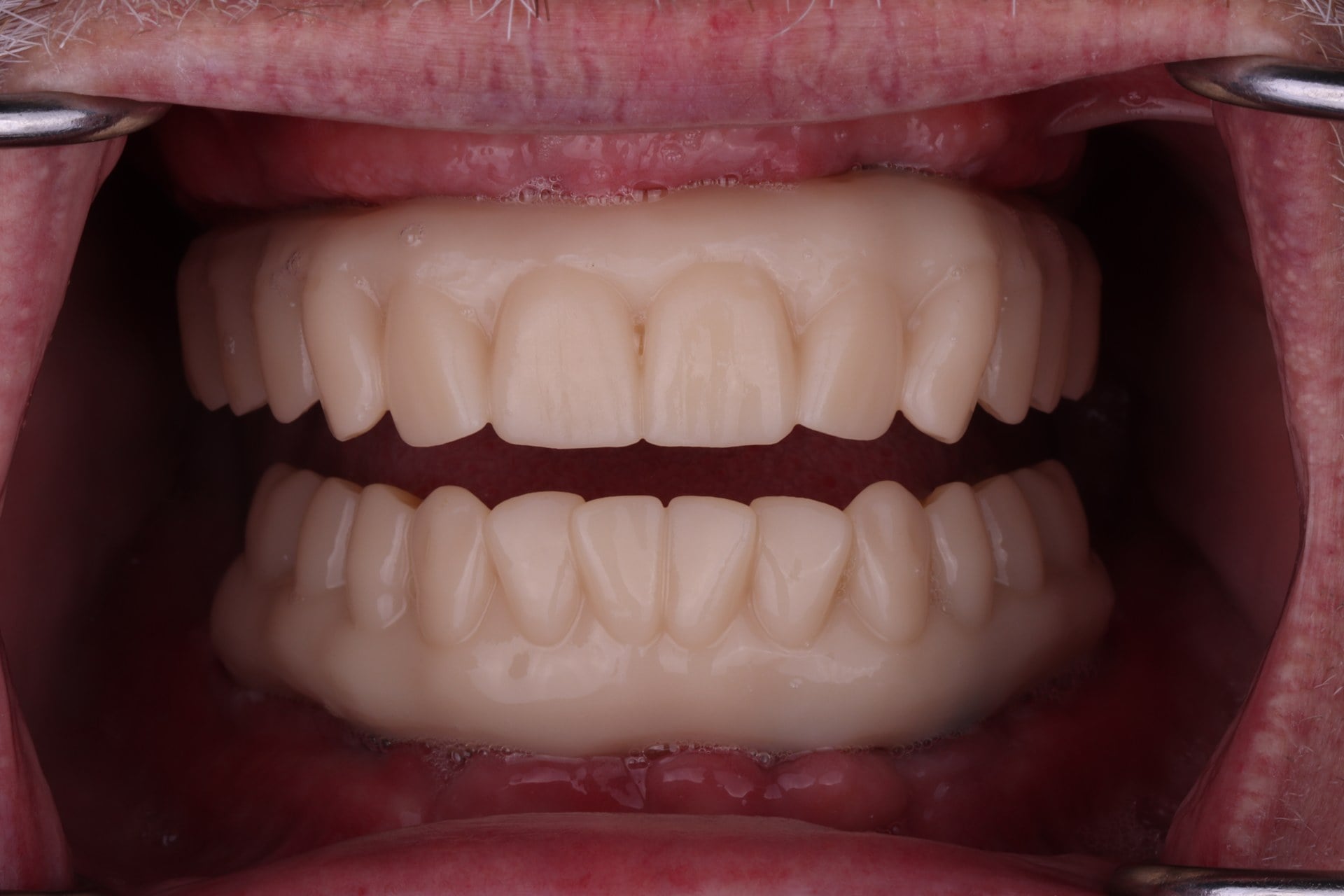 Yaste_03_Final_Case_Intraoral