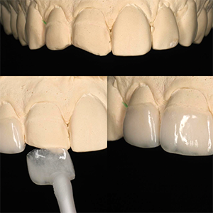 Feldspathic Veneers